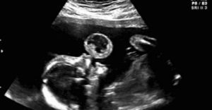 Počas ultrazvuku si mama myslela, že jej dieťa si robí bubliny. Krutá pravda ju zabolela