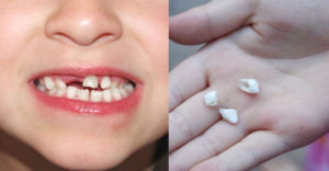 Nevyhadzujte mliečne zuby svojich detí. Jedného dňa im môžu zachrániť život