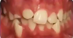 Strojček na zuby dokázal skutočný zázrak (Neuveriteľná zmena)