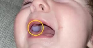 Lekári si mysleli, že bábätko má nádor v ústach. Ukázalo sa, že všetko je úplne inak