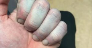 Ráno sa zobudil s modrou pokožkou a skončil na urgente: Lekári ho vysmiali